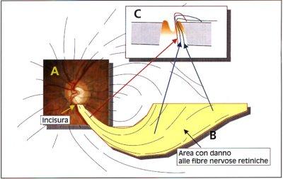 Fig. 1:  Un'incisura localizzata al polo inferiore della papilla (A) riflette un danno alle fibre nervose retiniche che decorrono in modo arciforme (B) dando come risultato un difetto arciforme del campo visivo. Una sezione della papilla (C) evidenzia come fibre nervose provenienti da aree peripapillari (freccia rossa) sono situate centralmente nel nervo ottico, mentre fibre provenienti da aree periferiche (freccia verde) sono localizzate vicino alla guaina del nervo. Un'alterazione situata a met strada tra la sclera e l'escavazione papillare comporta un difetto paracentrale (freccia blu).