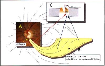 Fig. 1:  Un'incisura localizzata al polo inferiore della papilla (A) riflette un danno alle fibre nervose retiniche che decorrono in modo arciforme (B) dando come risultato un difetto arciforme del campo visivo. Una sezione della papilla (C) evidenzia come fibre nervose provenienti da aree peripapillari (freccia rossa) sono situate centralmente nel nervo ottico, mentre fibre provenienti da aree periferiche (freccia verde) sono localizzate vicino alla guaina del nervo. Un'alterazione situata a met strada tra la sclera e l'escavazione papillare comporta un difetto paracentrale (freccia blu).