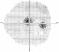 (cliccare) Fig. 3: Scotoma paracentrale.