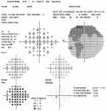 (cliccare) Fig. 6: Depressione generalizzata del campo visivo. Ragazza di 15 anni con glaucoma giovanile e ipertono oculare (38 mmHg). La deviazione totale  anormale (in basso a sinistra) e la deviazione localizzata  entro i limiti normali (in basso a destra). L'analisi della scala dei grigi (in alto a destra) non d informazioni particolarmente utili in tali casi.