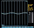 (cliccare) Fig. 2B: PERG standard ottenuto mediante stimolazione "steady state". Pazienti con glaucoma (da notare la ridotta larghezza).