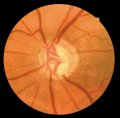 (cliccare) Fig. 1b: Incisura localizzata del margine neuroretinico.