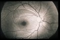 (cliccare) Fig. 2: Un difetto denso cuneiforme, ma ristretto, del RNFL, localizzato nello strato superiore delle fibre nervose arcuate dell'occhio destro di un paziente di 53 anni. La normalit di altre aree del fondo oculare  identificabile dal riflesso bianco dei fasci di assoni.