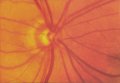 (cliccare) Fig. 3: Fotografia della papilla in occhi con glaucoma. Occhi con alterazione glaucomatosa precoce della papilla. Il bordo neuroretinico ha perso la sua forma normale; essa  diventata pi o meno uguale come estensione su tutto il contorno papillare (vedi testo).