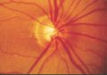 (cliccare) Fig. 4: Fotografia della papilla in occhi con glaucoma. Occhi con alterazione glaucomatosa precoce della papilla. Il bordo neuroretinico ha perso la sua forma normale; essa  diventata pi o meno uguale come estensione su tutto il contorno papillare (vedi testo).