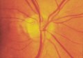 (cliccare) Fig. 5a: Fotografia della papilla in occhi con glaucoma. Occhio glaucomatoso senza apparenti lesioni papillari.
