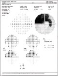 (cliccare) Fig. 2: Tipico scotoma arciforme con risposta anormale al Glaucoma Hemifield Test (A).