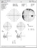(cliccare) Fig. 3: Salto nasale evidenziato particolarmente da una mappa di probabilit di deviazione dal modello normale (A) con conseguente anormalit del Glaucoma Hemifield Test (B).