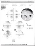 (cliccare) Fig. 4: Difetto paracentrale poco profondo riprodotto nella scala dei grigi (A). La mappa di probabilit di deviazione dal modello (B) evidenzia un sicuro difetto del campo visivo, con conseguente anormalit del Glaucoma Hemifield Test (C).