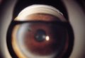 (cliccare) Fig. 4: Aspetto dell'angolo in un caso di glaucoma da chiusura d'angolo cronicizzato. La transizione tra angolo aperto e chiuso  chiaramente visibile.